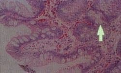 Metaplasia intestinal especializada
