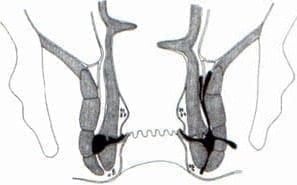 Vías de diseminación Vías de diseminación
