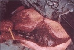 Fascitis Necrotizante del Periné (Gangrena de Fournier )