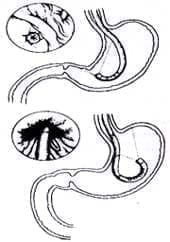 Maniobras de retroflexión del duodeno Maniobras de retroflexión del duodeno