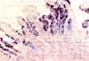 Aspecto morfológico de la metaplasia intestinal incompleta Aspecto morfológico de la metaplasia intestinal incompleta