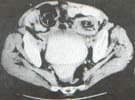 Tomografía axial del abdomen Tomografía axial del abdomen