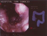 Lesiones submucosas colon izquierdo Lesiones submucosas colon izquierdo