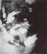 Colon por enema Colon por enema
