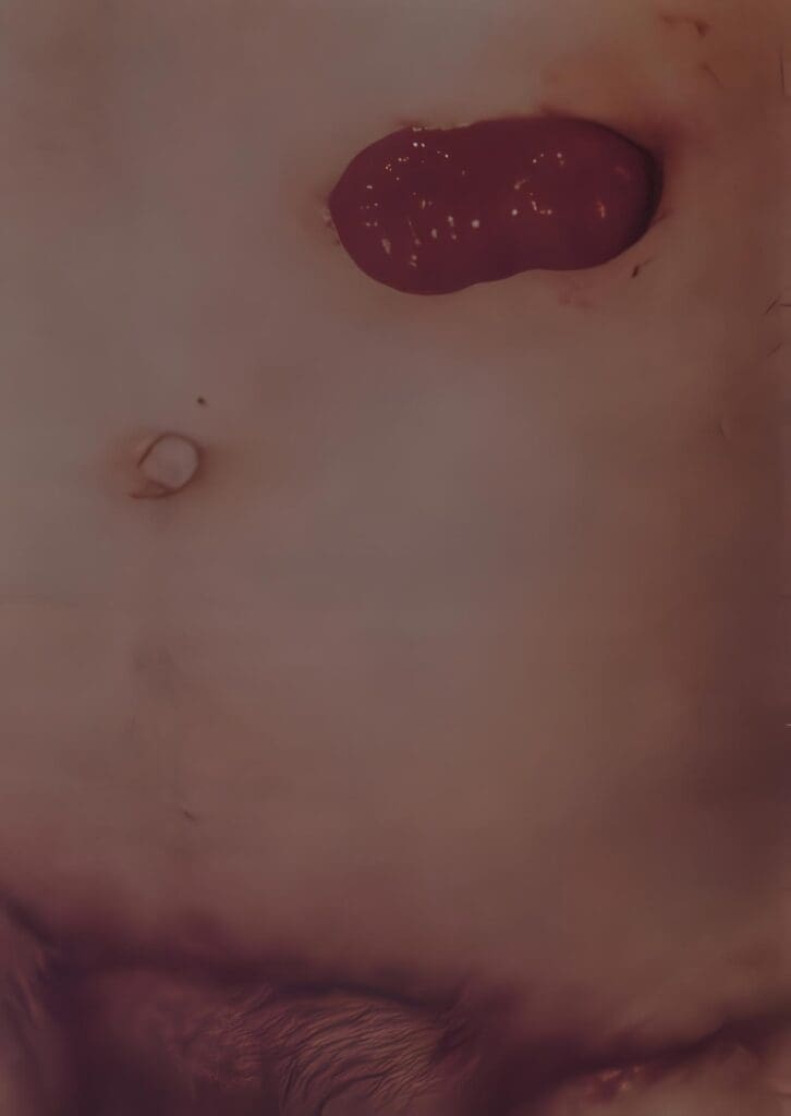 Colostomía