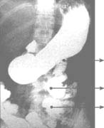 Control postoperatorio intestino corto Control postoperatorio intestino corto