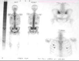 Gammagrafía ósea Gammagrafía ósea