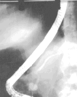 Quiste del colédoco tipo III Quiste del colédoco tipo III