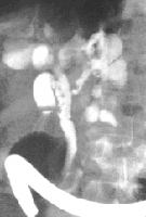 Quiste del colédoco tipo V Quiste del colédoco tipo V