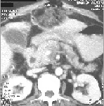 TAC abdominal que muestra drenaje  TAC abdominal que muestra drenaje