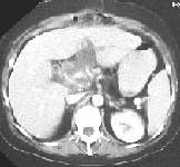TAC abdominal que muestra absceso de cabeza de páncreas TAC abdominal que muestra absceso de cabeza de páncreas