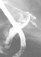 CPRE con disminución de la obstrucción distal posterior CPRE con disminución de la obstrucción distal posterior