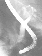 Evidencia de permeabilidad distal Evidencia de permeabilidad distal