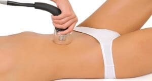 Beneficios de la Lipólisis Láser