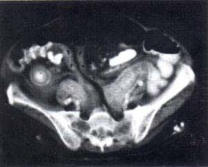 Engrosamiento de la Pared Intestinal Engrosamiento de la Pared Intestinal