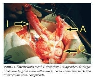Diverticulitis cecal  Diverticulitis cecal