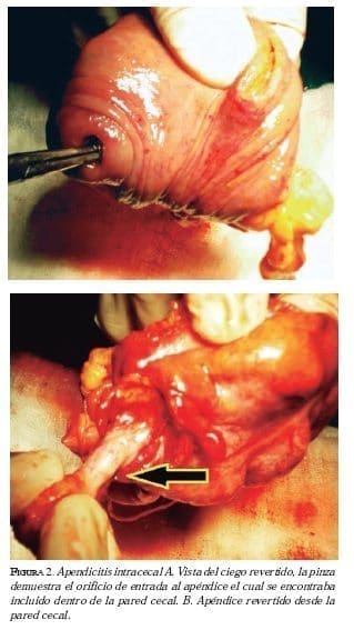 Apendicitis intracecal Apendicitis intracecal