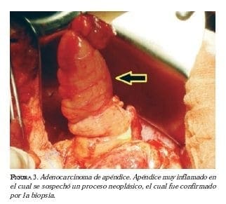 Adenocarcinoma de apendice Adenocarcinoma de apendice