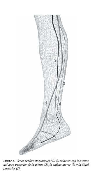 Venas perforantes - Insuficiencia venosa