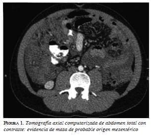 Tomografia axial, computarizada de abdomen total con contraste