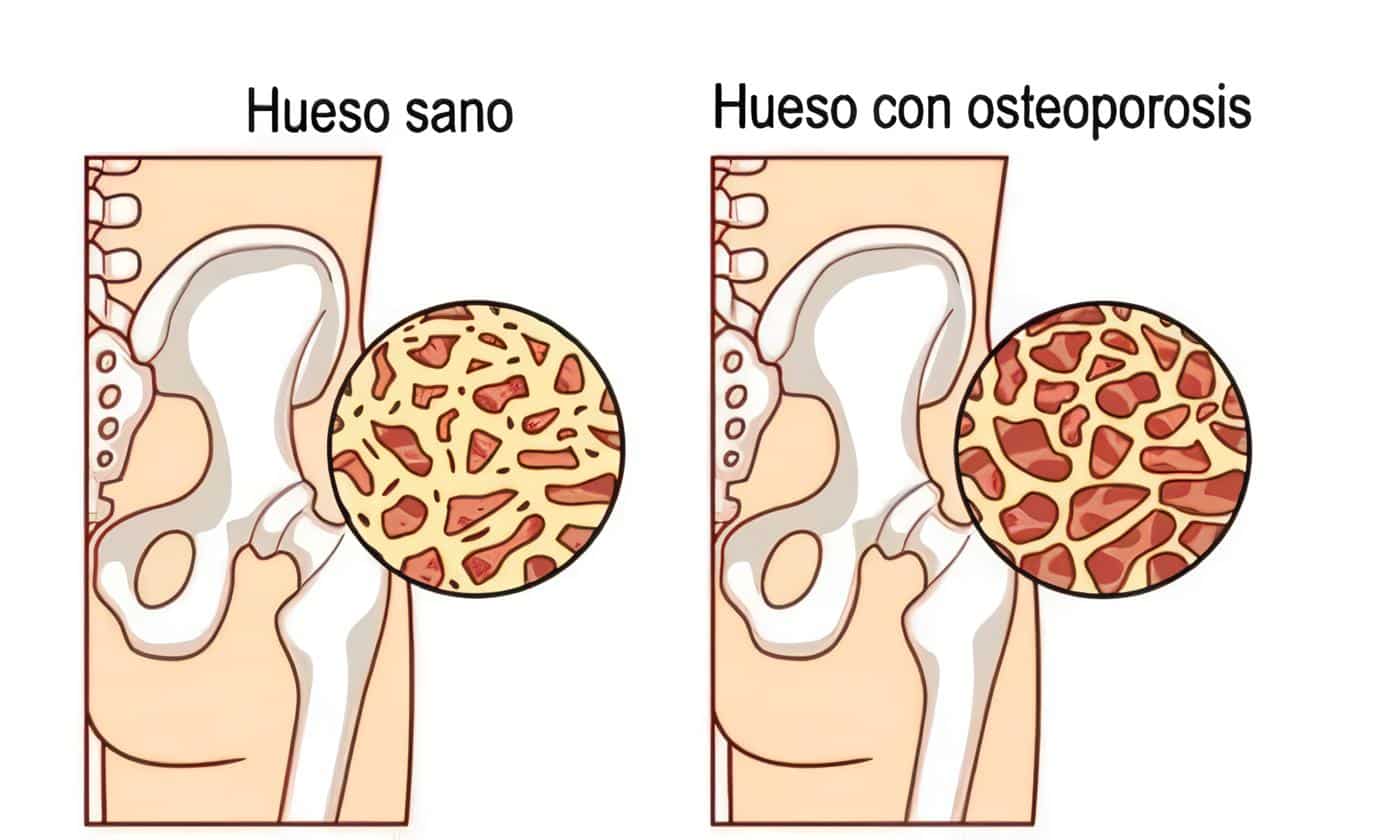 enf-cronicaosteoporosis