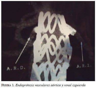 figura1-endoprotesis-vasculares