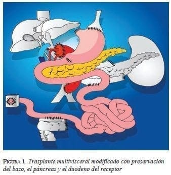 figura1-trasplante-multivisceral