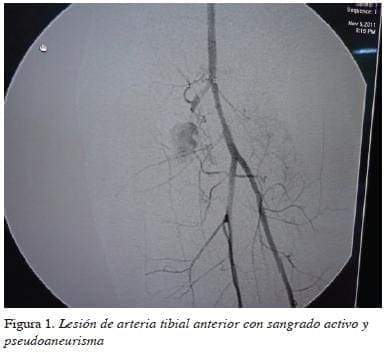 figura1lesion-de-arteria-tibial