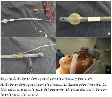 figura1tubo-endotraqueal