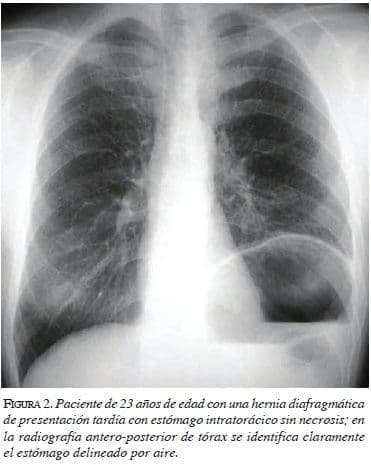 Hernia diafragmatica de presentación tardia figura2-hernia-diafragmatica