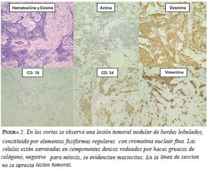 figura2-lesion-tumoral-nodular Lesion-tumoral-nodular