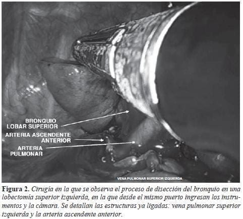 Cirugia en proceso de diseccion del bronquio figura2cirugia-en-proceso-de-diseccion-del-bronquio