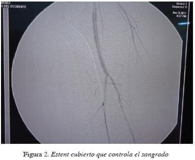 Estent cubierto que controla el sangrado figura2estent-cubierto