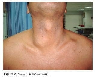 Masa pulsatil en el cuello