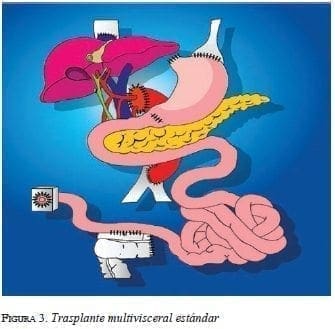 figura3-trasplante-multivisceral