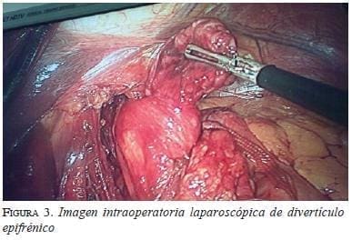 Imagen intraoperatoria laparoscopica de diverticulo epifrenico figura3imagen-intraoperatoria