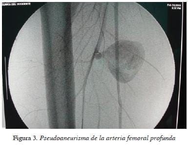 Pseudoaneurisma de la arteria femoral profunda figura3pseudoaneurisma-de-la-arteria-femoral