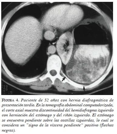 Hernia Diafragmatica de Presentación Tardia figura4-hernia-diafragmatica