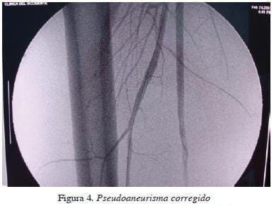 Pseudoaneurisma corregido figura4pseudoaneurisma-corregido