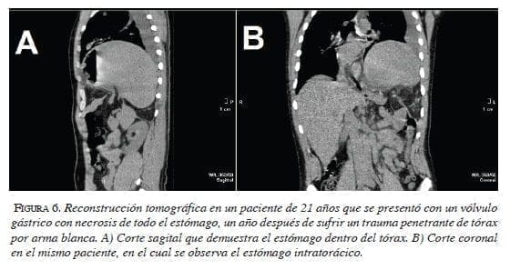 Reconstrucción Vólvulo Gástrico figura6-reconstruccion-volvulo-gastrico