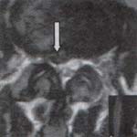 Corte axial de una RM Corte axial de una RM