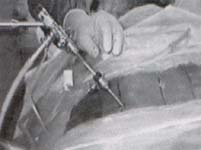 Endoscopia rigido de vision frontal KESS