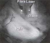 Imagen endoscopica descomprension discal Imagen endoscopica descomprension discal