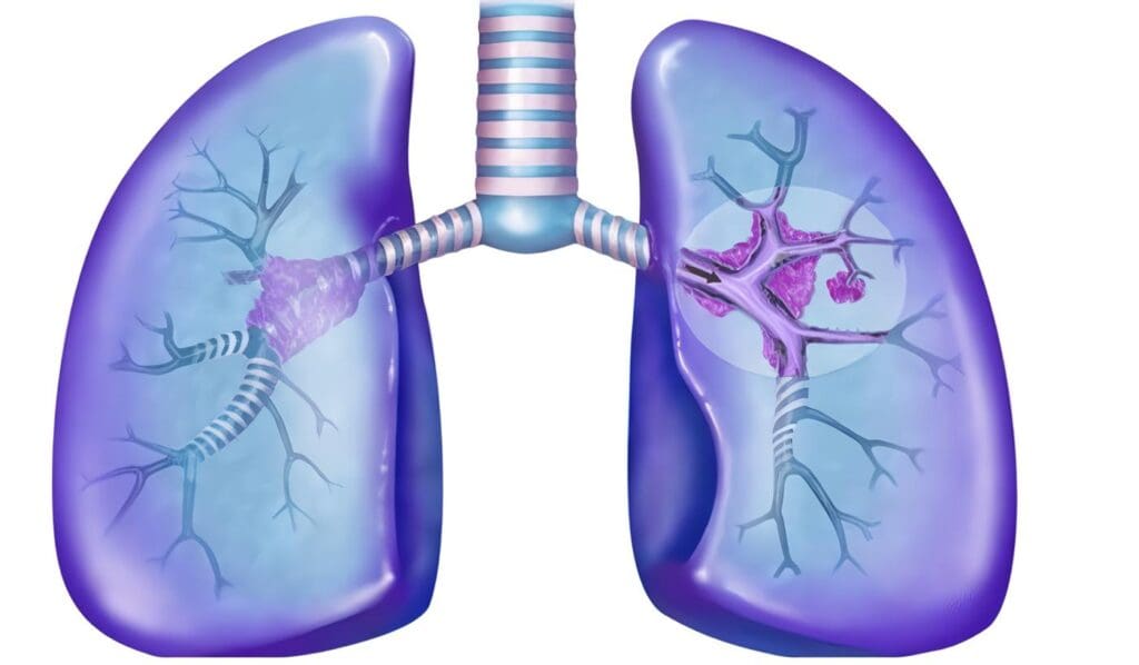 Etapas cáncer pulmón
