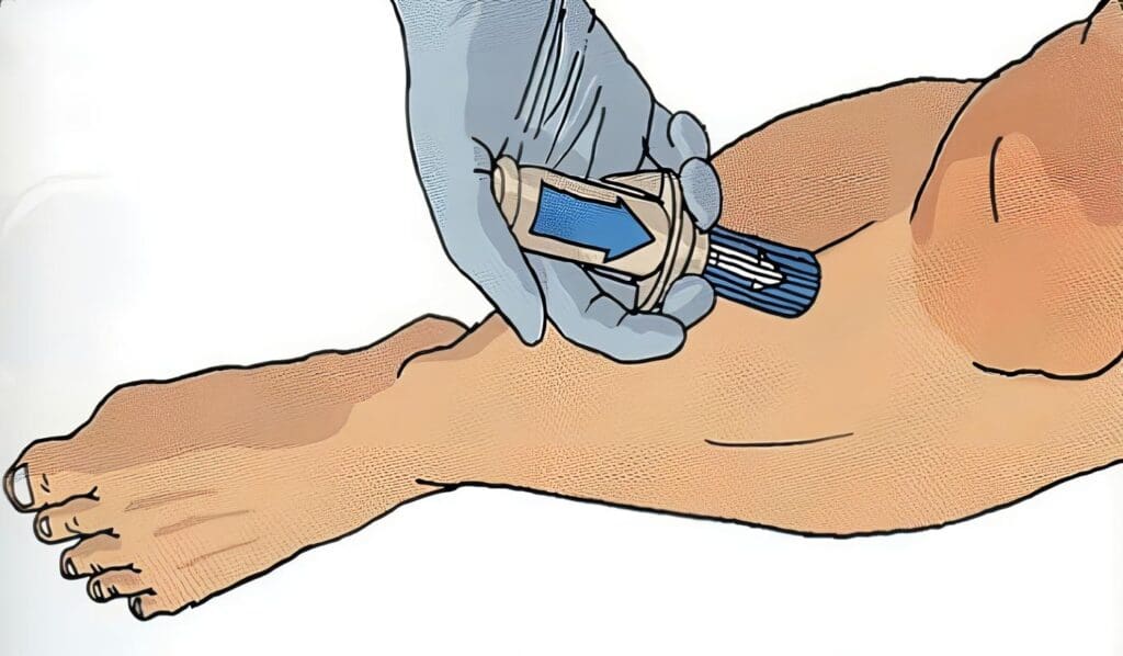 canalizacion intraosea