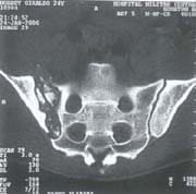 Tomografía axial computarizada que evidencia osteolisis y secuestros óseos Tomografía axial computarizada que evidencia osteolisis y secuestros óseos