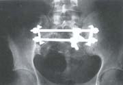 Vista radiográfica anteroposterior de la técnica Vista radiográfica anteroposterior de la técnica