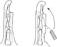 Colgajo homodigital invertido con flujo retrogrado Colgajo homodigital invertido con flujo retrogrado