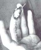 Quemadura eléctrica sobre 5° dedo Quemadura eléctrica sobre 5° dedo