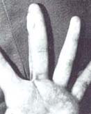 Quemadura eléctrica sobre 5° dedo Quemadura eléctrica sobre 5° dedo